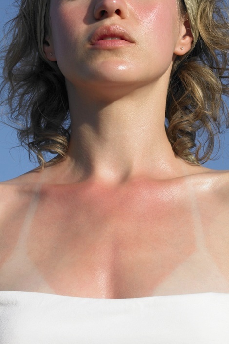 The Problem: Sunburn Prevention is the first line of defense—and new SPF technology makes shielding your skin at the beach or pool easier than ever. But hey, no one (and no sunscreen) is perfect and sometimes burns happen.
The Solution: Ice-cold compresses can reduce the pain and cool your skin, says dermatologist Jeanine Downie, MD, who also suggests using hydrocortisone cream. But if you're not able to get relief at home, see a doctor. She recommends the prescription wound-healer Biafine, used for years in Europe to soothe everything from sunburn to biopsy surgical wounds.
